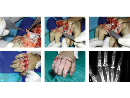 LCP_Rotation_Correction_Plate_2-0_3