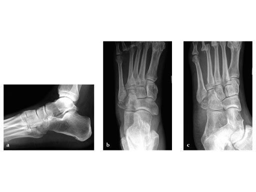 Locking_Cuboid_Plate_2-4_2