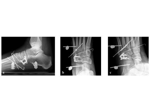 Locking_Cuboid_Plate_2-4_3