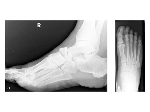 Locking_Navicular_Plate_2-4_2