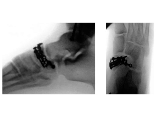 Locking_Navicular_Plate_2-4_3