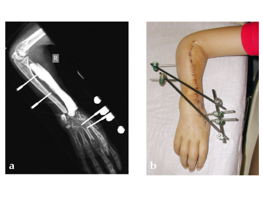 Modular_Mini_Fragment_LCP_2-1_2-4_2-7_4