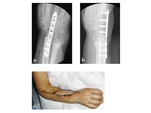 Modular_Mini_Fragment_LCP_2-1_2-4_2-7_6