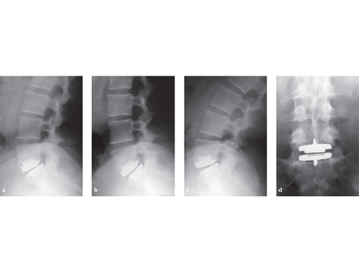 ProDisc-L-ProDisc-C_6