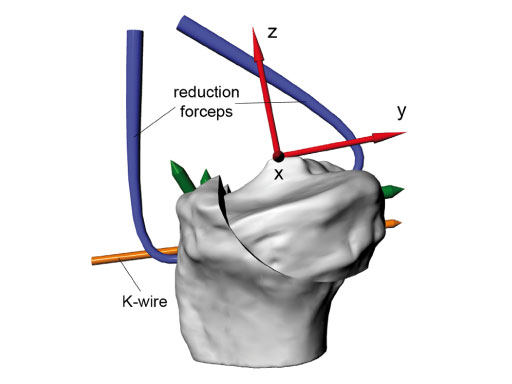 Tibia_Plateau_Leveling_Osteotomy_Plate_new_5