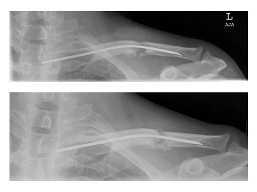 ElasticNailing_TEN_10