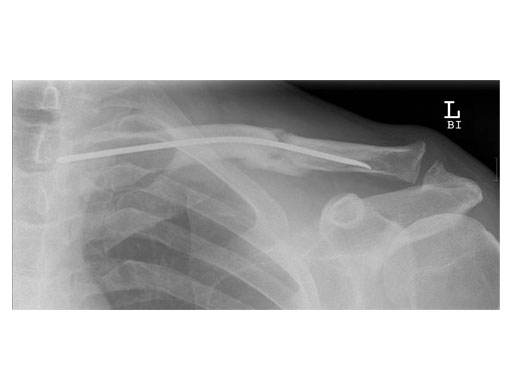 ElasticNailing_TEN_11