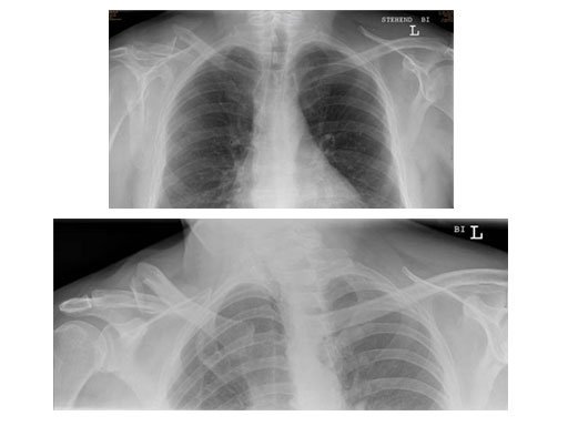 ElasticNailing_TEN_6