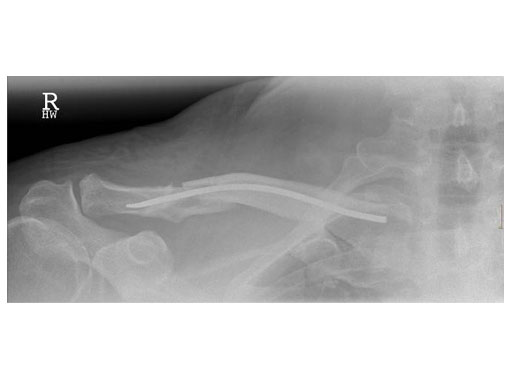 ElasticNailing_TEN_7