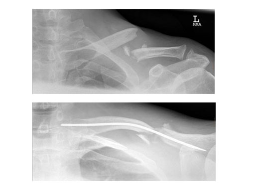 ElasticNailing_TEN_9