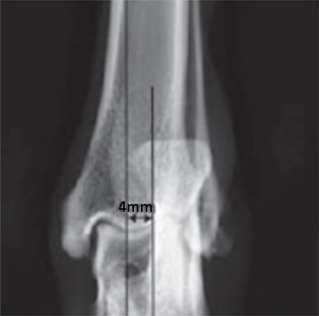 Fig. 4: Lateral preoperative x-rays; tibial plateau slope is 20.