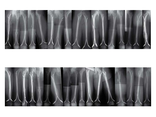 1stClinExpEndCapsElStblIntramedNailingFemShftFxChildren_1