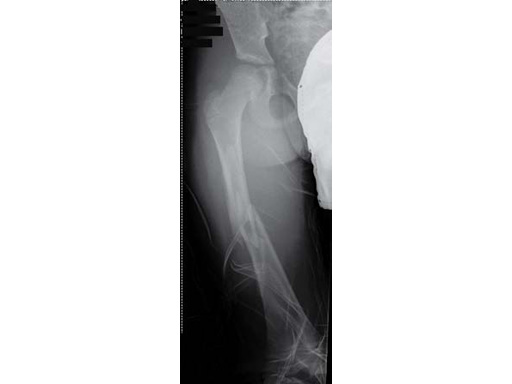 1stClinExpEndCapsElStblIntramedNailingFemShftFxChildren_2