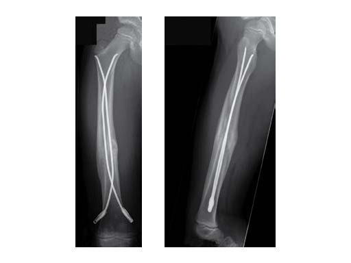 1stClinExpEndCapsElStblIntramedNailingFemShftFxChildren_4