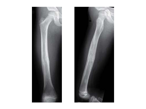 1stClinExpEndCapsElStblIntramedNailingFemShftFxChildren_5