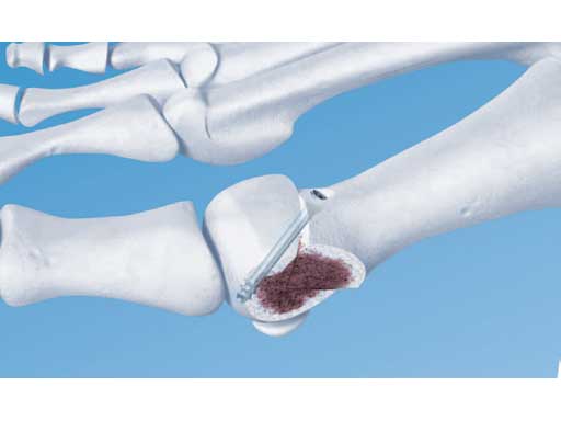 2-4_3-0_HeadlessCompressionScrews_1