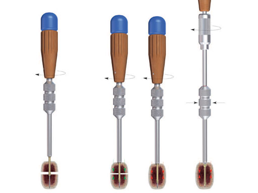 2-4_3-0_HeadlessCompressionScrews_4