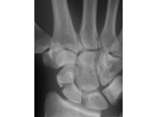 2-4_3-0_HeadlessCompressionScrews_5