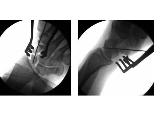 2-4_3-0_HeadlessCompressionScrews_6