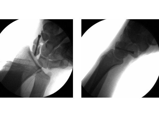 2-4_3-0_HeadlessCompressionScrews_7