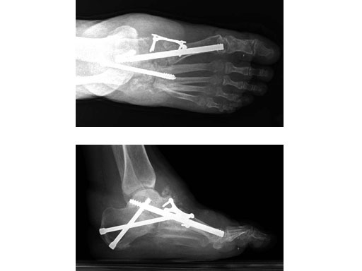6-5mmMidfootFusionBolt_4