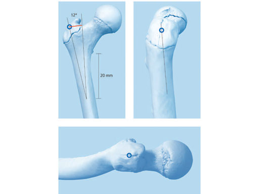 AdolescentLateralEntryFemoralNail_2