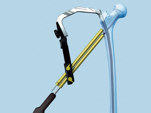 AdolescentLateralEntryFemoralNail_3