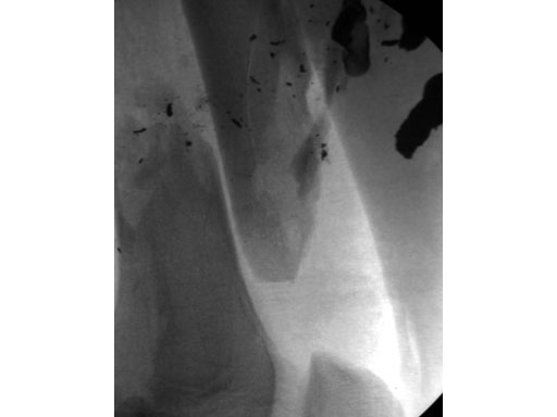 AdolescentLateralEntryFemoralNail_4