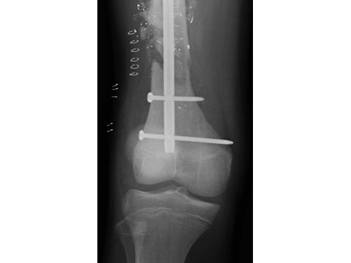 AdolescentLateralEntryFemoralNail_5