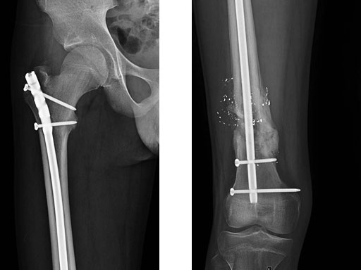 AdolescentLateralEntryFemoralNail_6