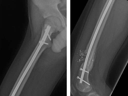 AdolescentLateralEntryFemoralNail_7