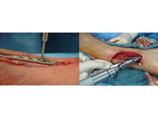 DrillSuctionDevice_2