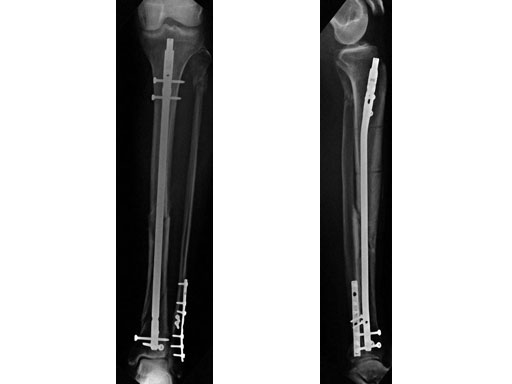 ExpertTitaniumCannulatedTibialNailwProximalBend_4