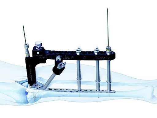 LCPPeriarticularAimingInstruments_1