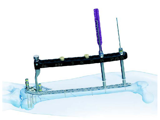 LCPPeriarticularAimingInstruments_2