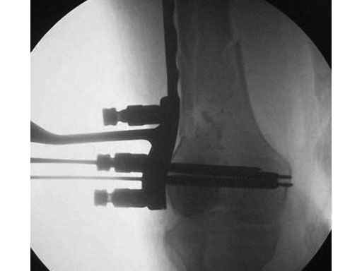 LCPPeriarticularAimingInstruments_3