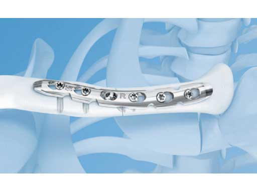 LCPSuperiorAnteriorClavicle_1