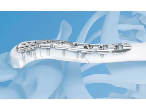 LCPSuperiorAnteriorClavicle_2