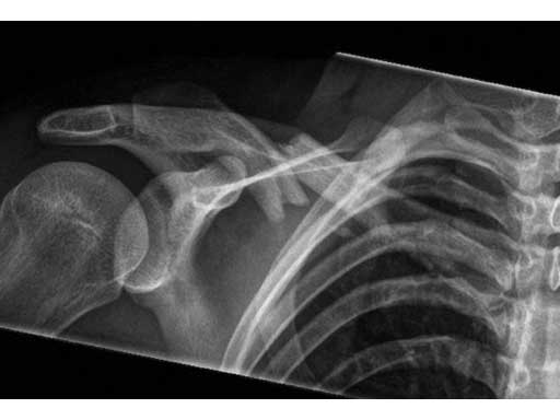 LCPSuperiorAnteriorClavicle_3