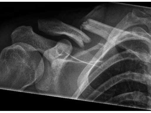LCPSuperiorAnteriorClavicle_4