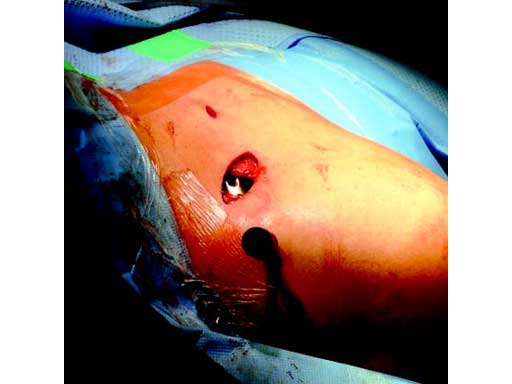 LCPSuperiorAnteriorClavicle_5