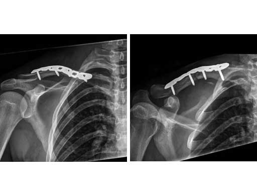 LCPSuperiorAnteriorClavicle_6