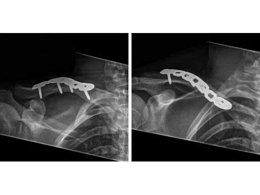 LCPSuperiorAnteriorClavicle_7