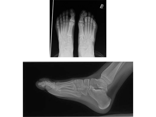 LockingXPlate_2-4_2-7_ExtraSmall_2