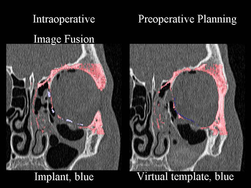 MatrixPreformedOrbitalPlates_10