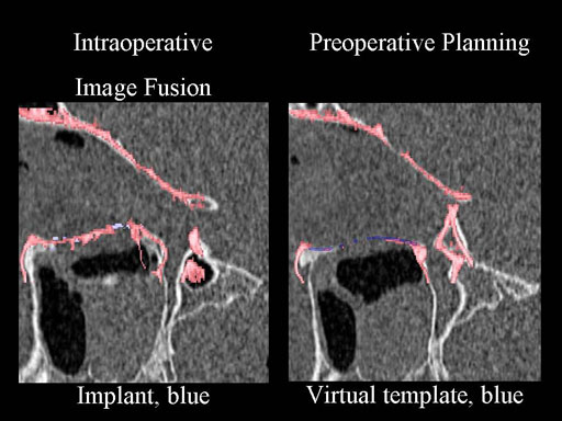 MatrixPreformedOrbitalPlates_11