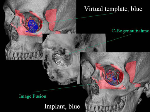 MatrixPreformedOrbitalPlates_12