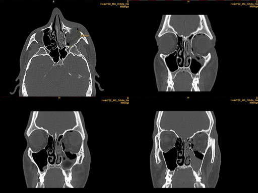 MatrixPreformedOrbitalPlates_13