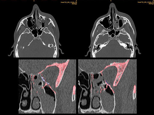 MatrixPreformedOrbitalPlates_14
