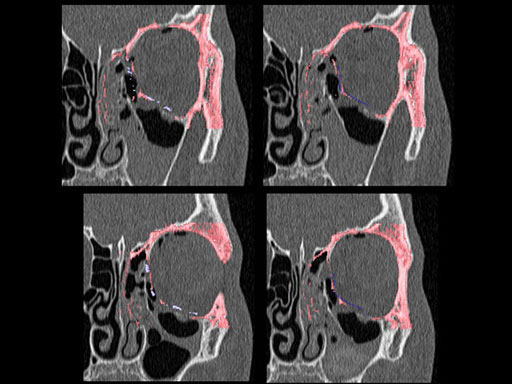 MatrixPreformedOrbitalPlates_15